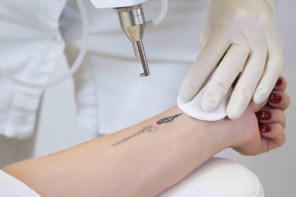 laser tattoo removal clinic in Delhi NCR